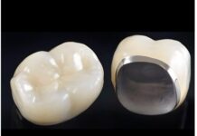 Металокераміка чи цирконій? Вся правда про те, коли «класика» надійніша за дорогі рішення.